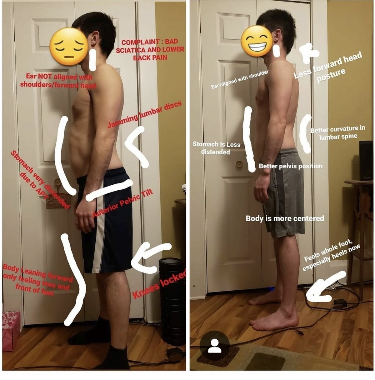 Two side-profile photos of the same client. Before, on the left: forward head, anterior pelvic tilt, distended stomach, locked knees, weight on the toes. After, on the right: ear over shoulder, better pelvis position, body centred, weight through the whole foot.