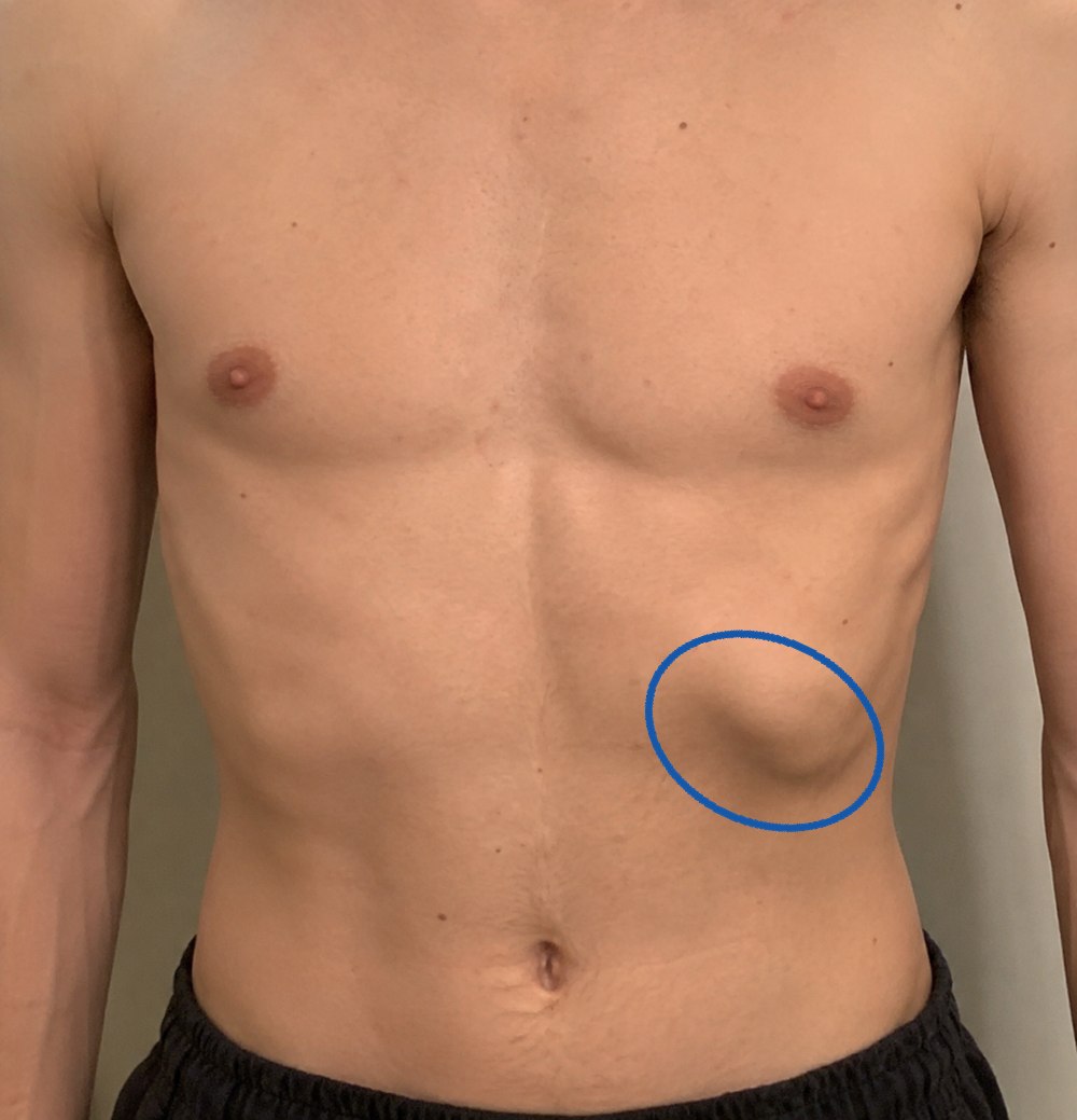 Front view of a torso from the collarbones to the waistband. The lower rib margin on his left side, which appears on the right of the photo, is circled where it sits higher and stands out further than the other side.